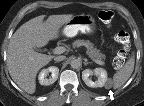 Renal Cell Carcinoma: Diagnosis, Staging, and Surveillance | AJR