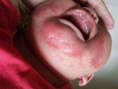 如何区分婴儿湿疹、痱子、痤疮等宝宝皮肤问题？