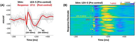 Mapping the Epileptogenic Brain Using Low-Frequency Stimulation: Two ...