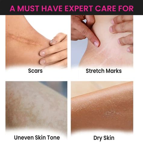 ThriveCo Skin Expert Skin Care Oil for Scars & Stretch Marks