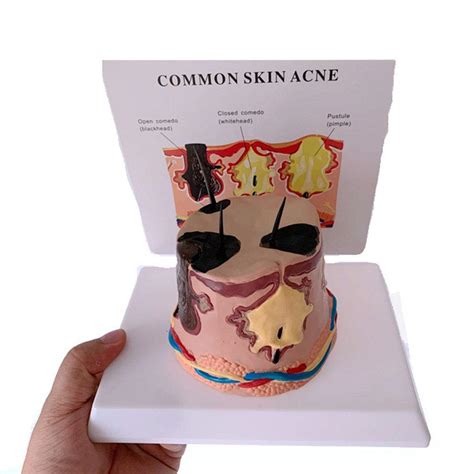 Buy LNDDP Human Pathology Round Skin Model, Pustule Inflammation Skin ...