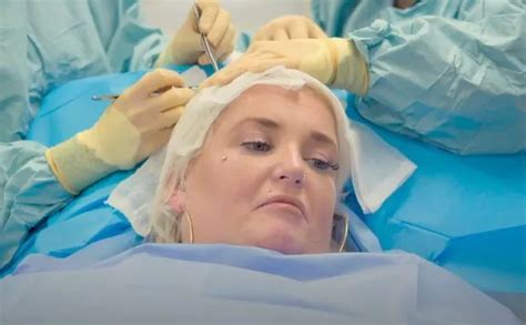 Largest Exploding Cyst 的图像结果