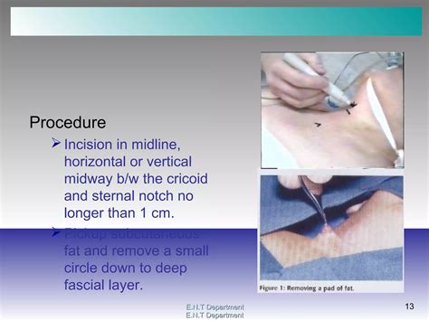 Image result for Trach Procedure