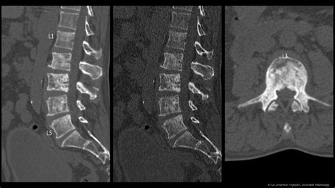 Ultimate Radiology : Sclerotic Skeletal Secondaries