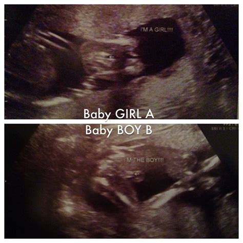 Its A Girl Ultrasound 16 Weeks