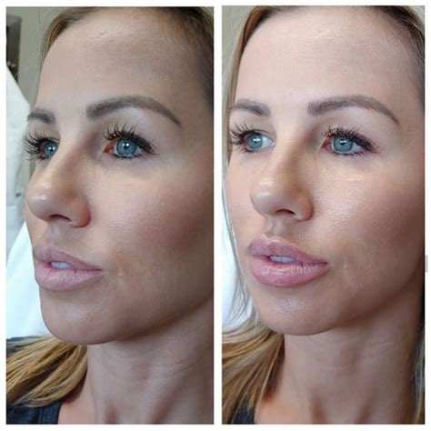 How Does Juvederm Work In Lips at Alonzo Caraway blog