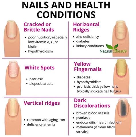 Pin by Afrikah on Nail Game | Fingernail health, Health, Zinc deficiency