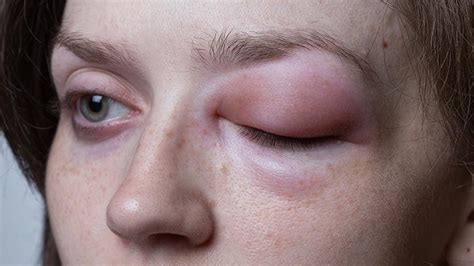 Rare Diseases Resource Center - All Articles