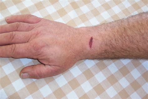 Gash Wound On Arm Free Stock Photo - Public Domain Pictures