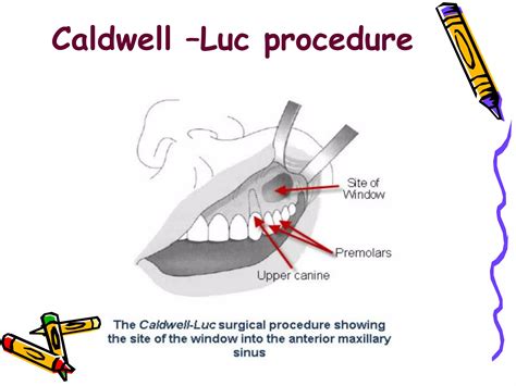 Caldwell Luc Procedure