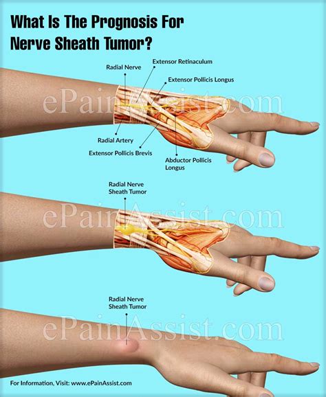 What Is The Prognosis For Nerve Sheath Tumor?