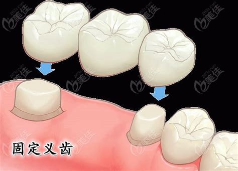 简述可摘局部义齿与固定义齿的区别,附带可摘局部假牙的3种支持方式_最热整形行业新闻话题 - 美佳网