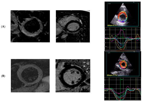 2D Strain Analysis in Myocarditis—Can We Be Any Closer to Diagnose the ...