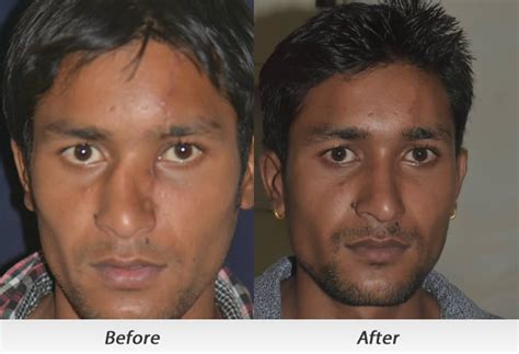Nasal Deformity After Traumaaccident | Cosmetic Rhinoplasty India