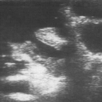 Hydrostatic Reduction of Intussusception 的图像结果