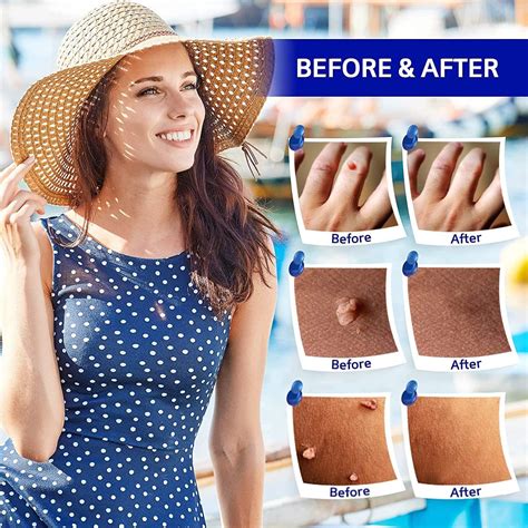 Getsocio Skin Tag & Mole Remover Set - Repair Skin, Remove Blemishes, Easy At-Home Removal | Buy ...