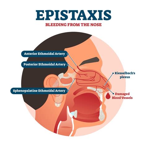 Epistaxis With High Blood Pressure