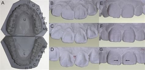 A Common Variation in EDAR Is a Genetic Determinant of Shovel-Shaped ...