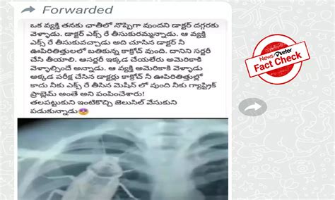 Fact Check: Did Doctor find a cockroach in a patient's radiograph?