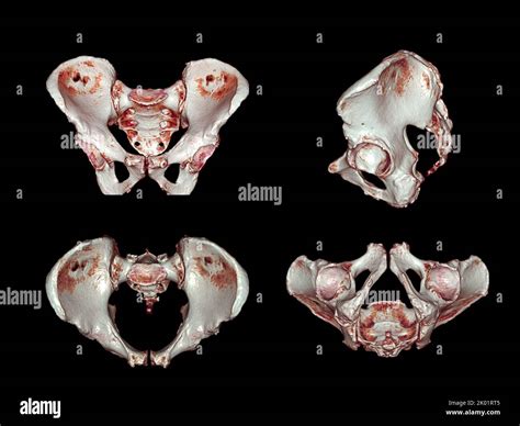 Ct Anatomy Of Pelvic Bones at Angela Link blog
