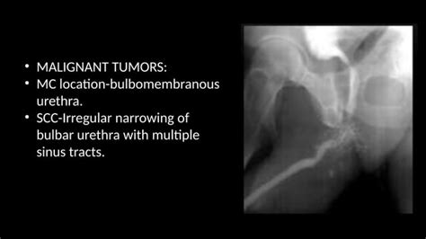 Image result for Retrograde Urethrogram RadioGraphics