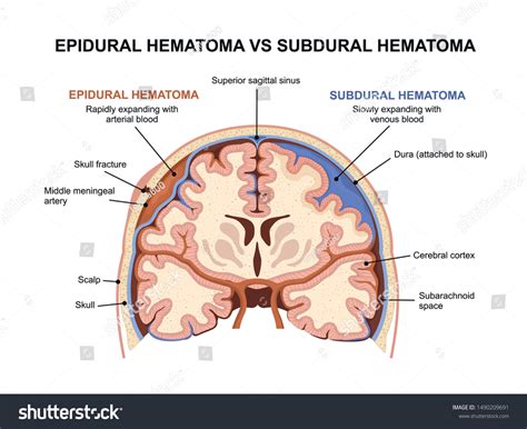 Subarachnoid Hemorrhage Vs Subdural Hematoma