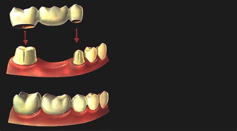 Teeth Replacement at Shwet Dental Clinic and Implant Center Prernatirth ...