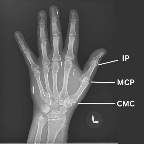 Thumb Pain In Joint? | Try These 3 Tips To Relieve Thumb Pain