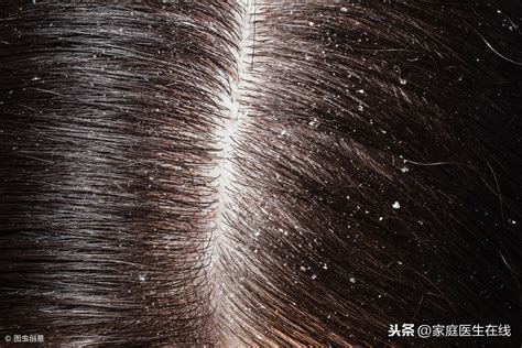 【头皮真菌感染脱发】【图】头皮真菌感染脱发怎么办 4个治疗方法帮你解决问题(2)_伊秀健康|yxlady.com