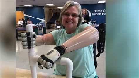 Woman who lost hands, feet to septic shock learning how to dance again