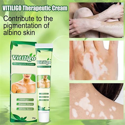 Buy Vitiligo Treatment, Leukoplakia - White Spots on Skin & Improve ...