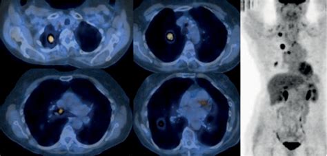 SciELO Brasil - PET/CT imaging in lung cancer: indications and findings ...