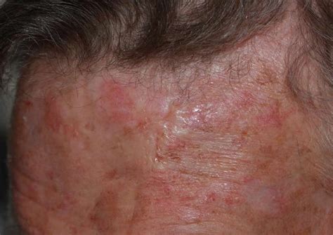 Basal Cell Carcinoma - Causes, Types, Symptoms, Prognosis, Treatment