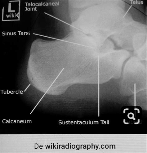 Distal clavicular osteolysis clavicle acromioclavicular joint weight ...
