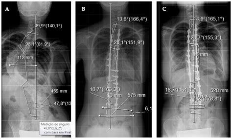 Benefits of Best Practice Guidelines in Spine Fusion: Comparable ...
