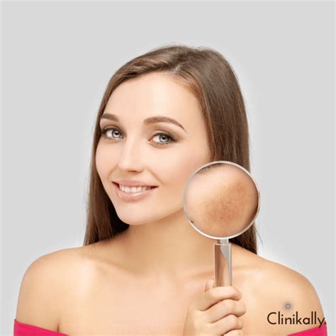 Dark Spots: Causes & Treatment - Dermatologist's Guide | Clinikally