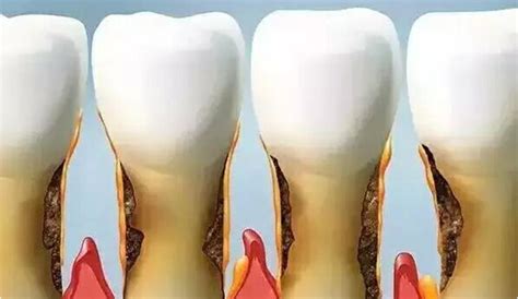 如何修复牙齿松动-爱康健齿科