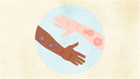 What Is Ringworm, and How Should You Treat It?