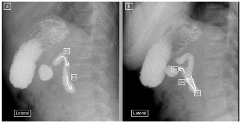 Quality and Diagnosis on the Lateral View of Pediatric Upper Gastro-Intestinal Series
