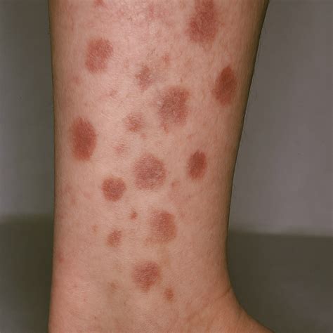 Diabetic Skin Conditions: Visual Guide & Pictures