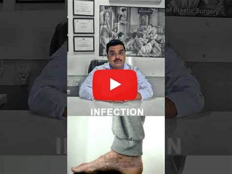 Charcot Foot Treatment: Expert Care at Surat Diabetic Foot Clinic