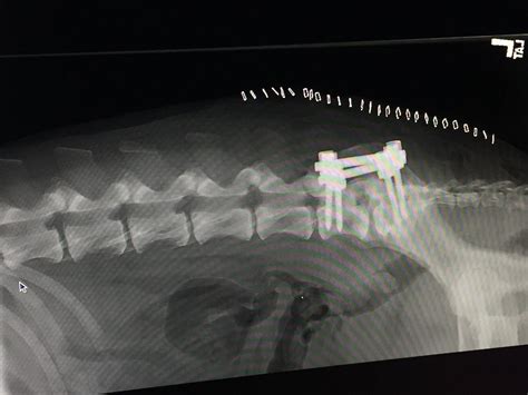 Image result for Spinal Stabilization Recovery