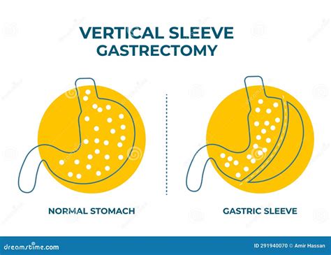Laparoscopic Sleeve Gastrectomy, Vertical Gastrectomy, Weight Loss Surgery Vector Illustration ...