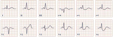 Broad Electrocardiogram Syndromes Spectrum: From Common Emergencies to ...