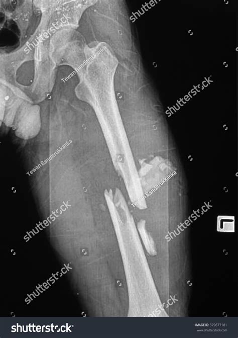 Broken Femur Xray