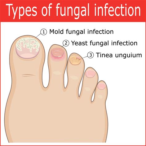 Cure Toenail Pain From Fungus Infection