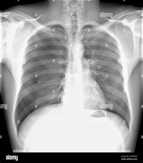 Pneumothorax. X-ray of the chest of a patient with a pneumothorax, or ...