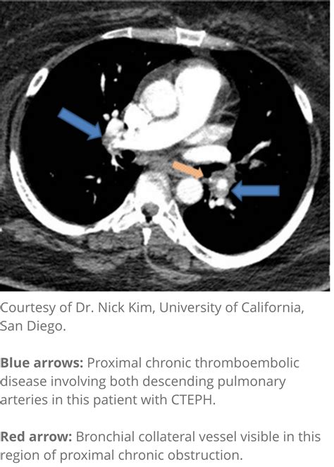 CTEPH | Assessing patients for pulmonary thromboendarterectomy in CTEPH