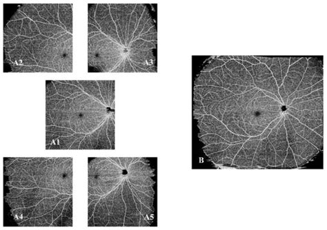 Analysis of White and Dark without Pressure in a Young Myopic Group ...