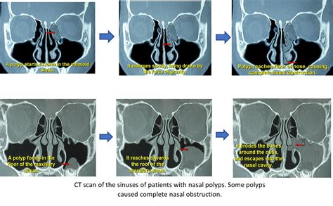Nasal Polyps Treatment in Singapore | Fungus Removal Surgery